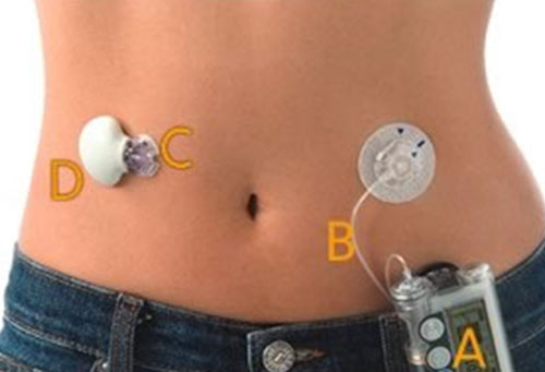 Different Types of CGM (Continuous Glucose Monitoring) Devices