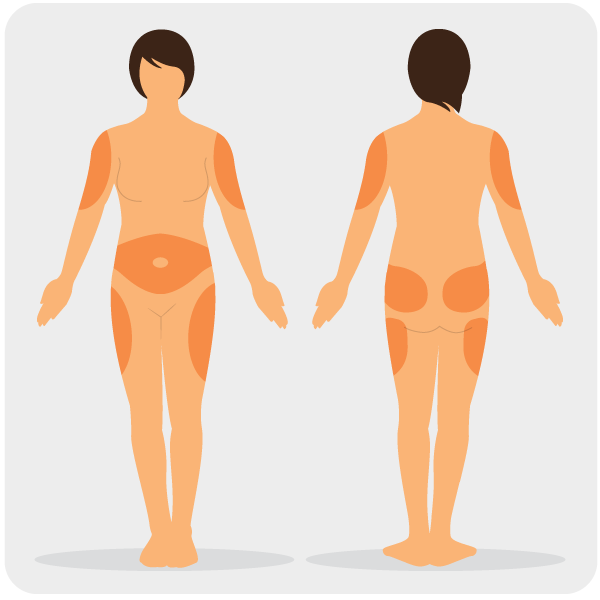 illustrated-diagram-of-insulin-injection-areas